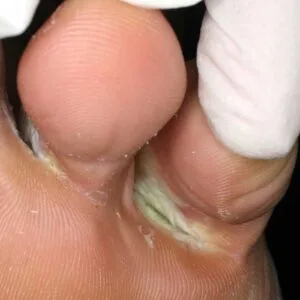 micosi piedi