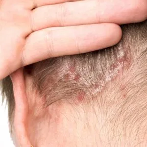 psoriasi del cuoio capelluto
