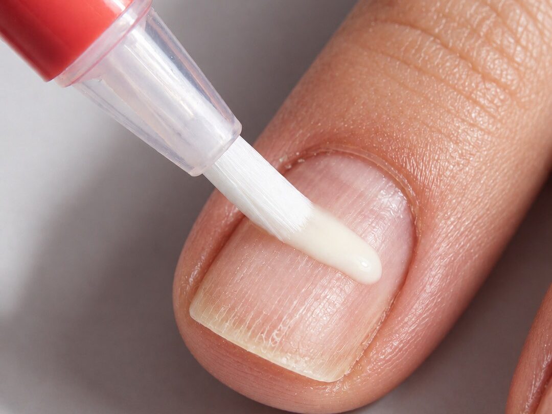 Applicazione onicosana su unghie fragili e rovinate Applicazione di onicosana con pennello su un'unghia naturale della mano, leggermente rovinata, con striature e sfaldamento superficiale.